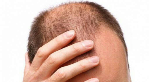 Saçkıran hastalığı nedir?