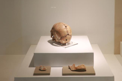 Dünyanın ilk beyin ameliyatına ait kafatası