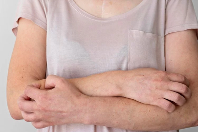 Cildiye profesörü uyardı: “Herkes her an uyuz olabilir”