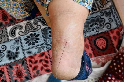 Ayak topuğundan 37 santim tel çıktı