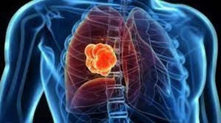 Akciğer Kanserinden Korunmanın 5 Yolu